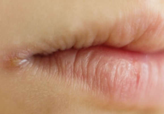 구순염의 발생원인