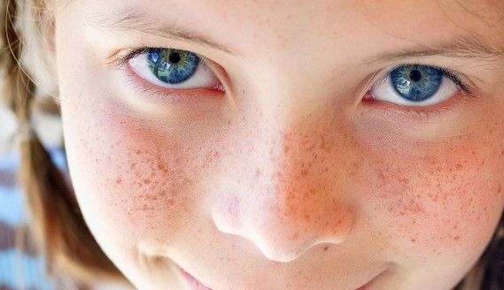 기미-주근깨-없애는법-검버섯제거-천연미백