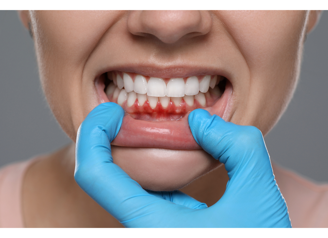 잇몸 붓는 이유와 원인, 완화&middot;관리 방법 정리