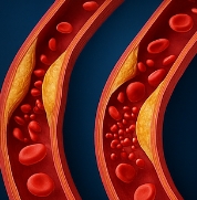 고혈압 낮추는 방법