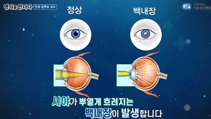 백내장설명2