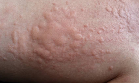 피부에 나타난 두드러기 증상