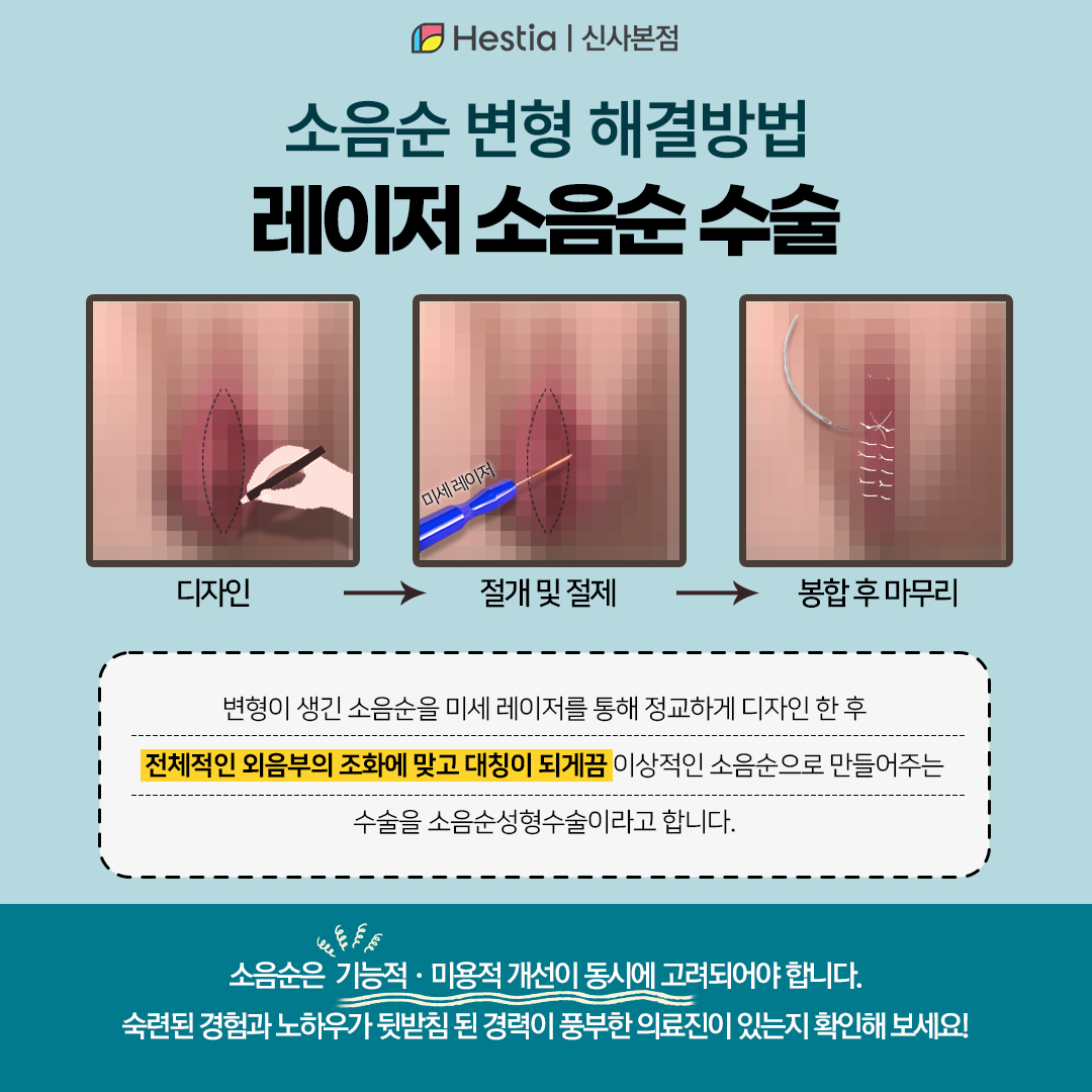 소음순 변형 치료방법 - 소음순성형수술