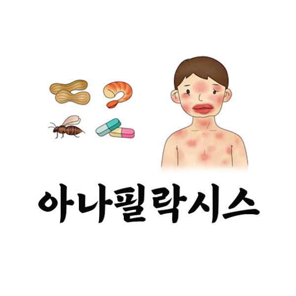 아나필락시스 썸네일