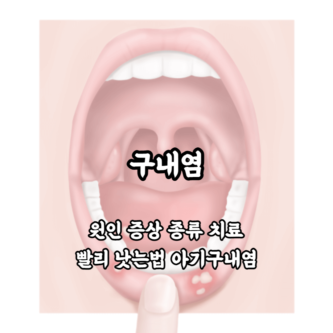 구내염 원인 종류 증상 치료 알보칠 연고 패치 영양제 빨리 낫는법 전염 아기 구내염