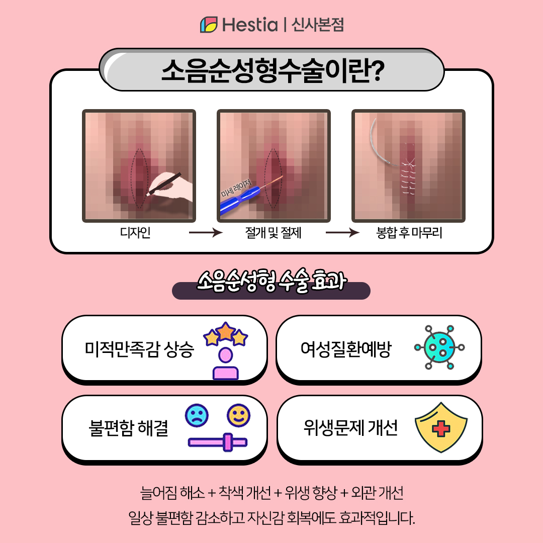 소음순성형수술이란?