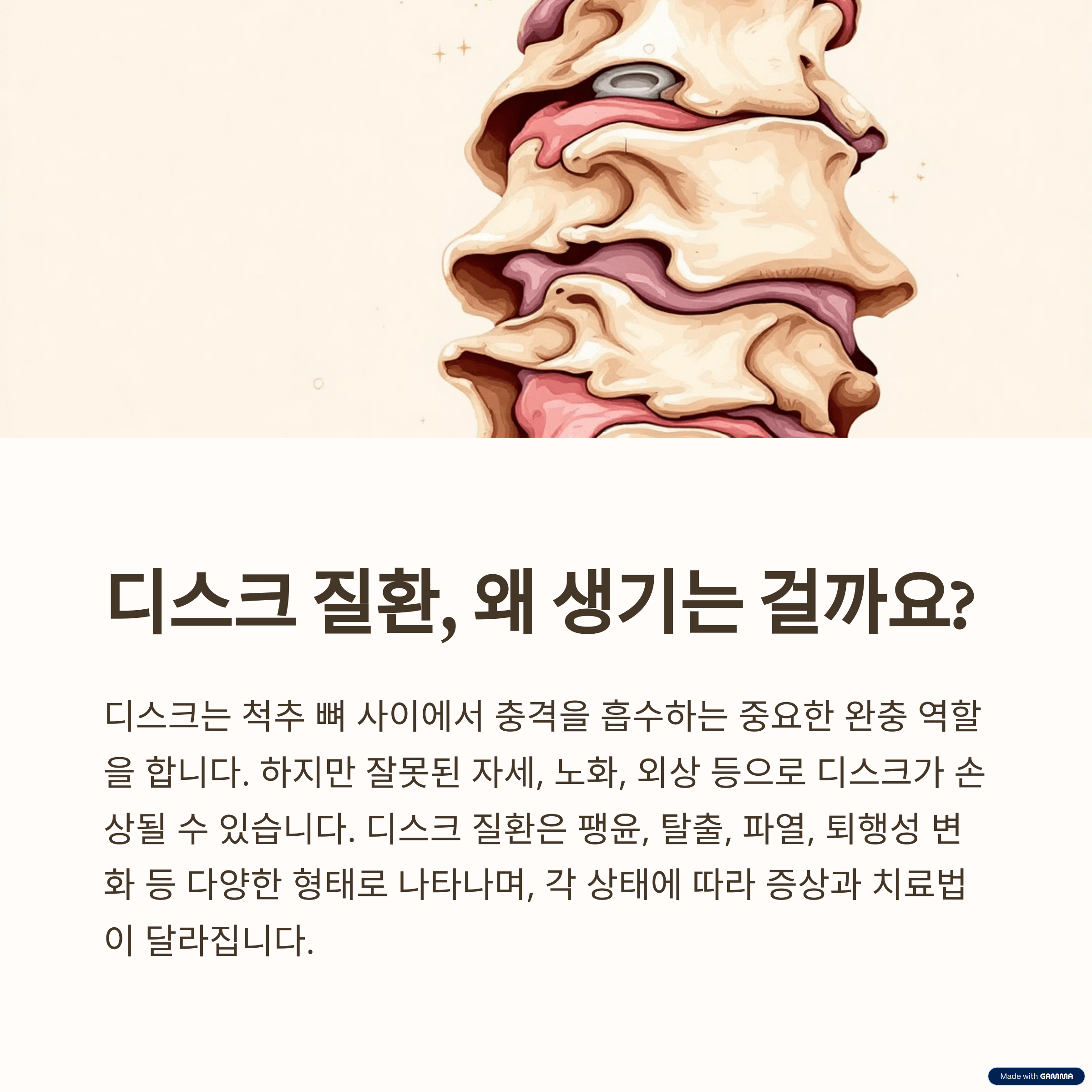 디스크 질환의 이해