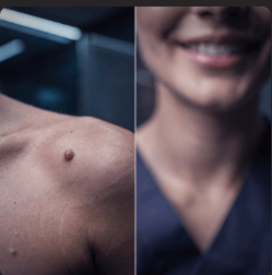 쥐젖 제거 방법