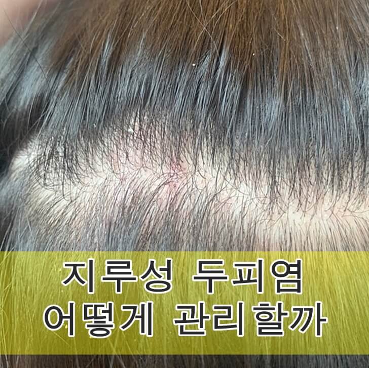 지루성 두피염 어떻게 관리할까