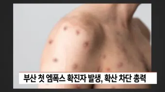엠폭스 증상 예방접종 대처법 치료방법_23