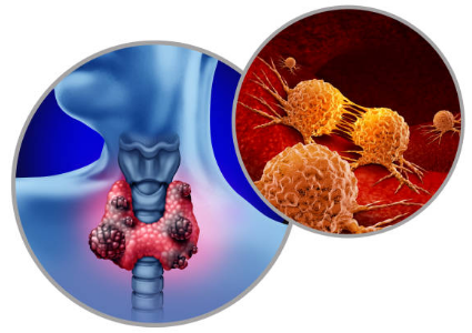 갑상선암 증상, 수술후 회복기간, 수술후 좋은음식 총정리 (2024ver)