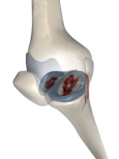 무릎 연골 손상