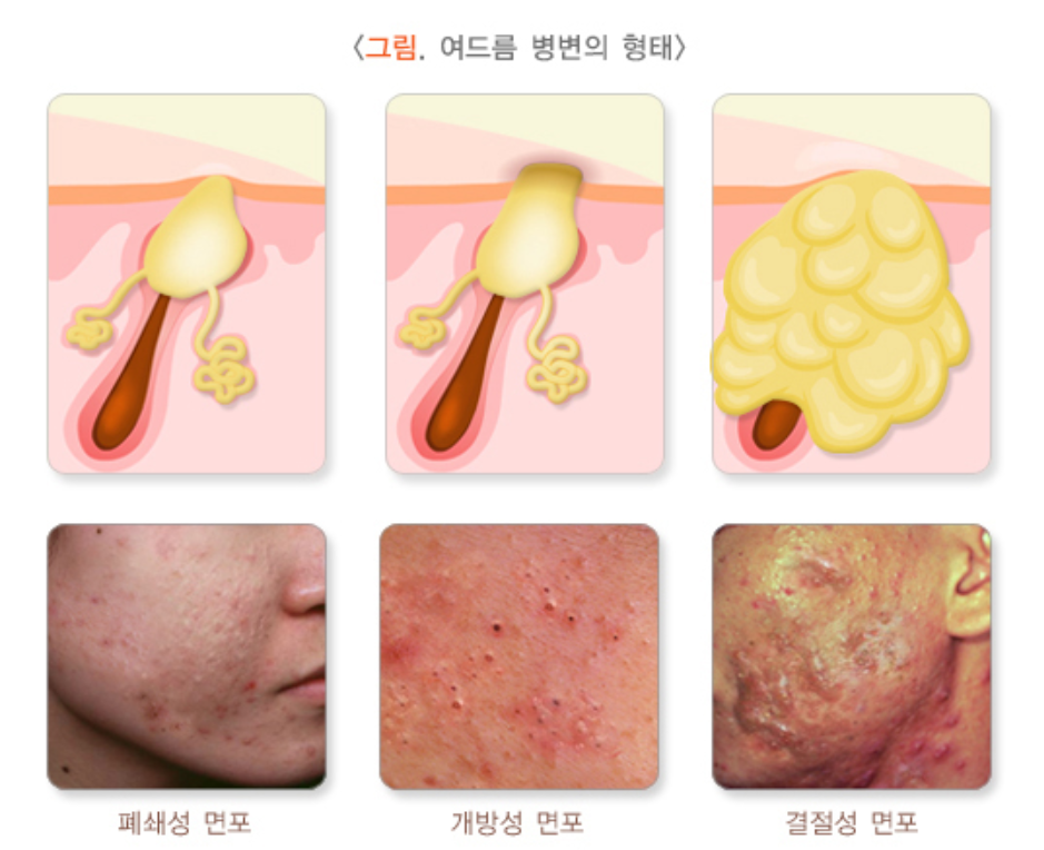 여드름 병변의 형태 사진