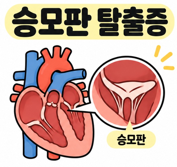 심장과 승모판 그림 옆에 승모판 탈출증 제목을 크게 배치한 카드