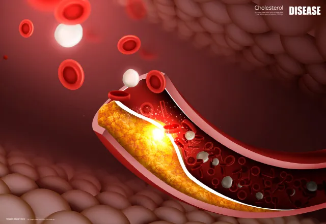 LDL 콜레스테롤 정상수치 낮추는법_4