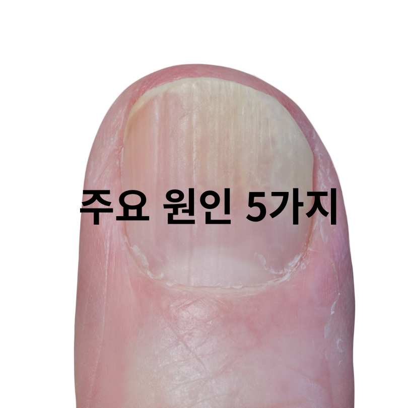 손톱에 검은 줄 증상,원인,치료법