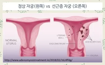 출산 후 자궁수축 기간_9