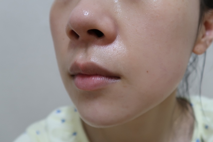 bbl 레이저 후기