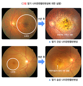 눈 떨림 증상&amp;#44; 언제 병원에 가야 할까?