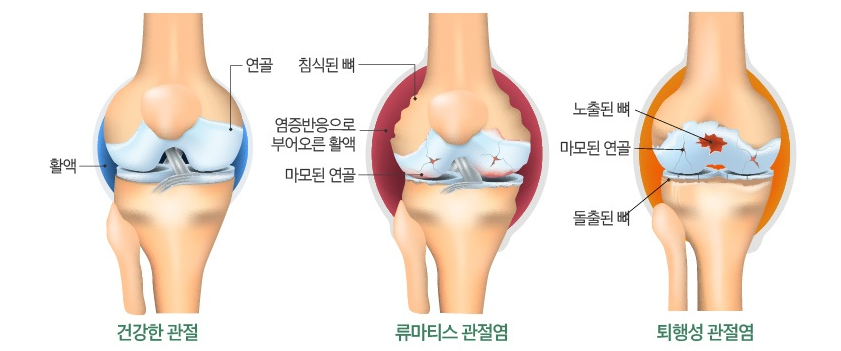 류마티스 관절염 증상