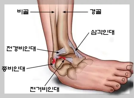 발목접질럿을때