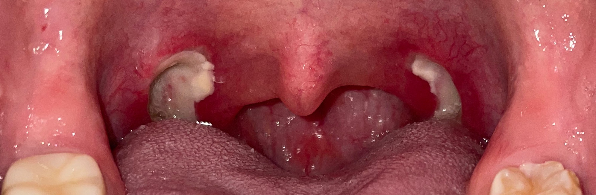 편도 절제 수술 4일차