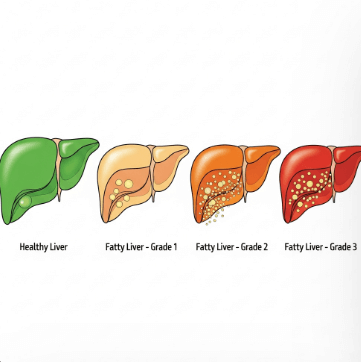 알콜성 지방간 초음파 검사17