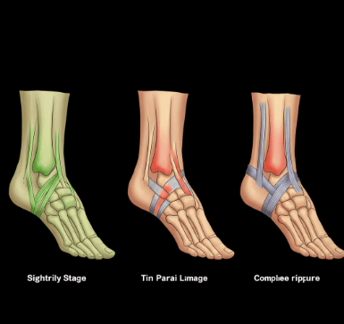 발목 염좌 vs 인대 손상 구분법4
