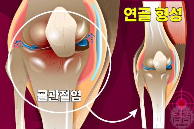 관절영양제 콘드로이친 효능 부작용 권장량 글루코사민 차이 연골재생