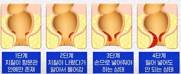 치질 수술 전 자가치질평가