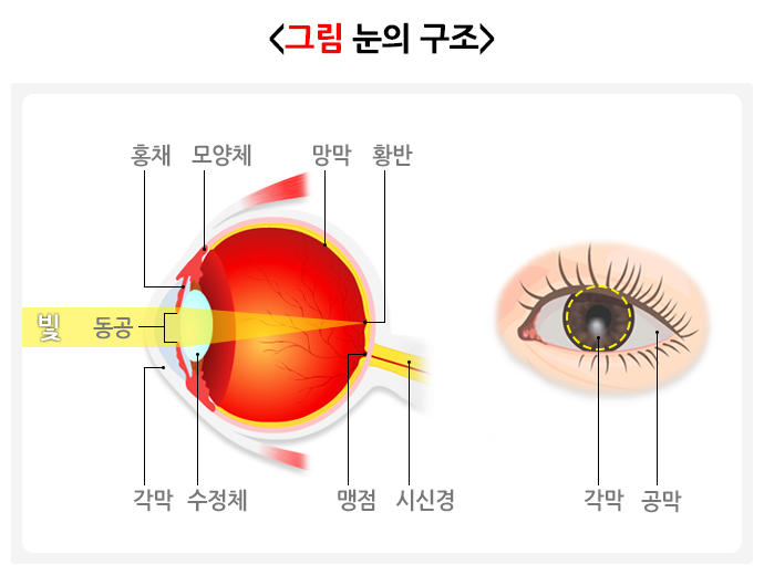 각막혼탁