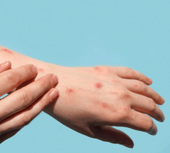 베트남 홍역 유행 손 반점