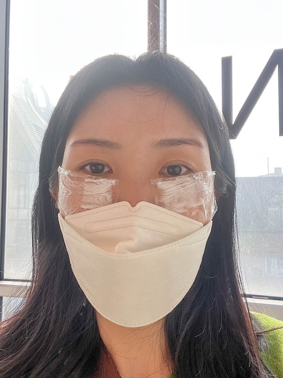 눈밑지방재배치 후기