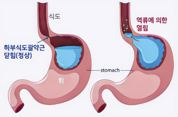 역류성식도염 설명 자료