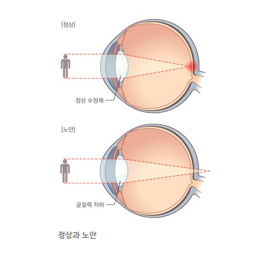 정상과 노안