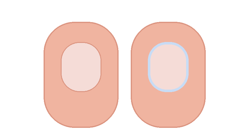 젤네일&middot;네일아트가 손톱을 망가뜨리는 이유: 얇아짐&middot;들림&middot;알레르기(HEMA)까지 전문 정리