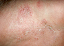 무좀 증상별 무좀약 추천