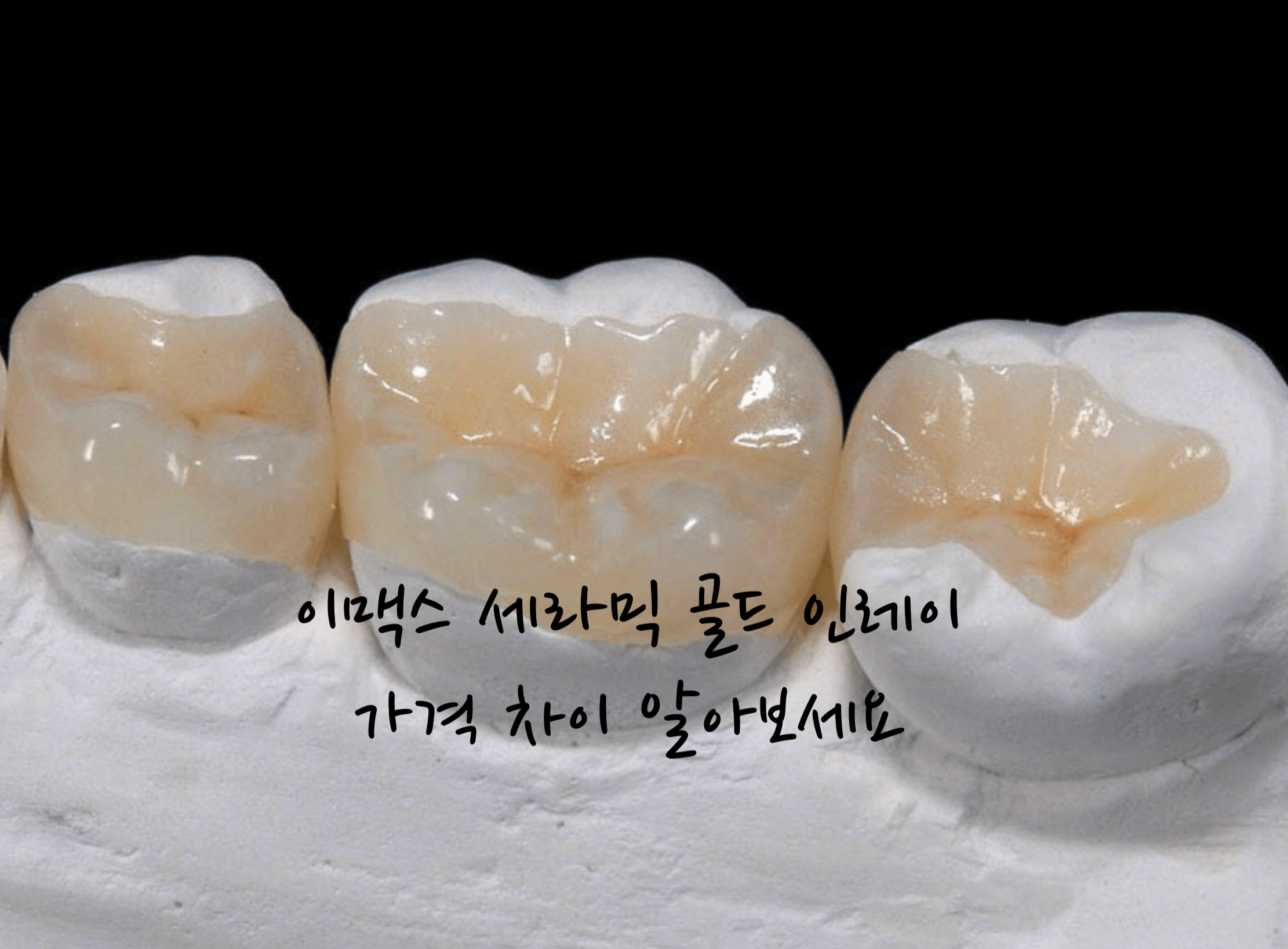 인레이