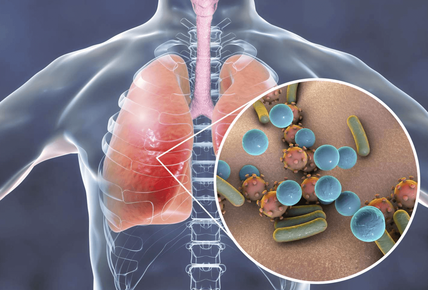 마이코플라즈마 폐렴