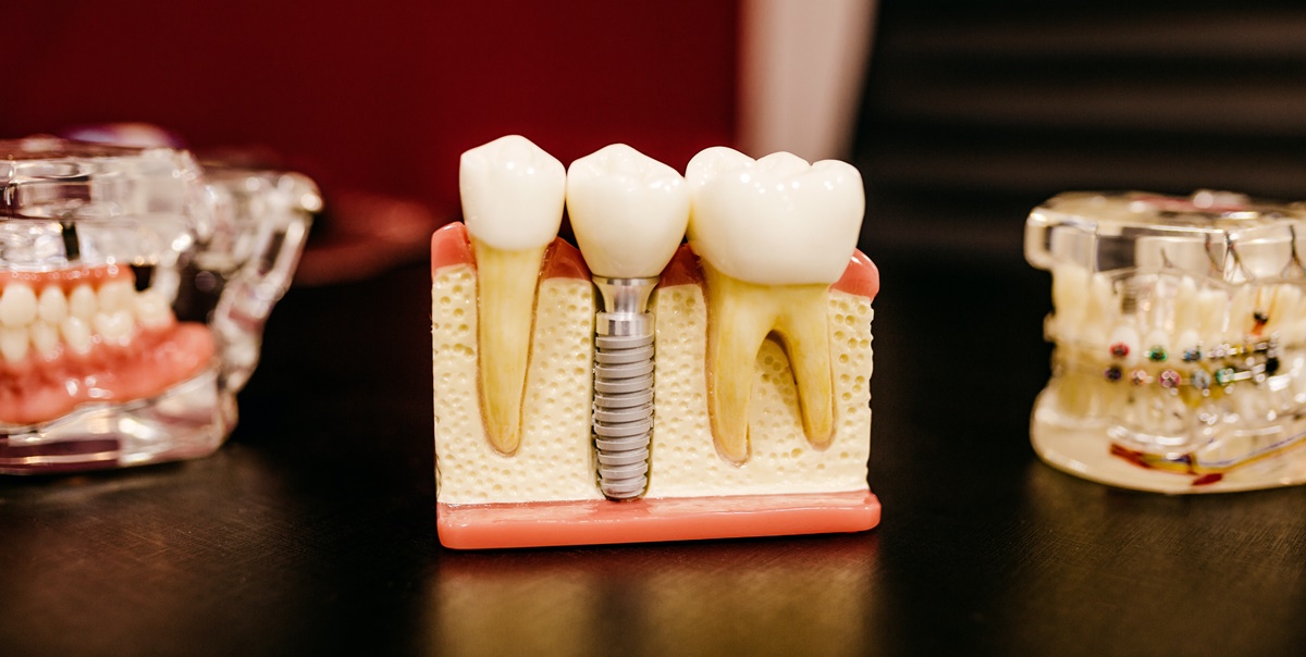 implant