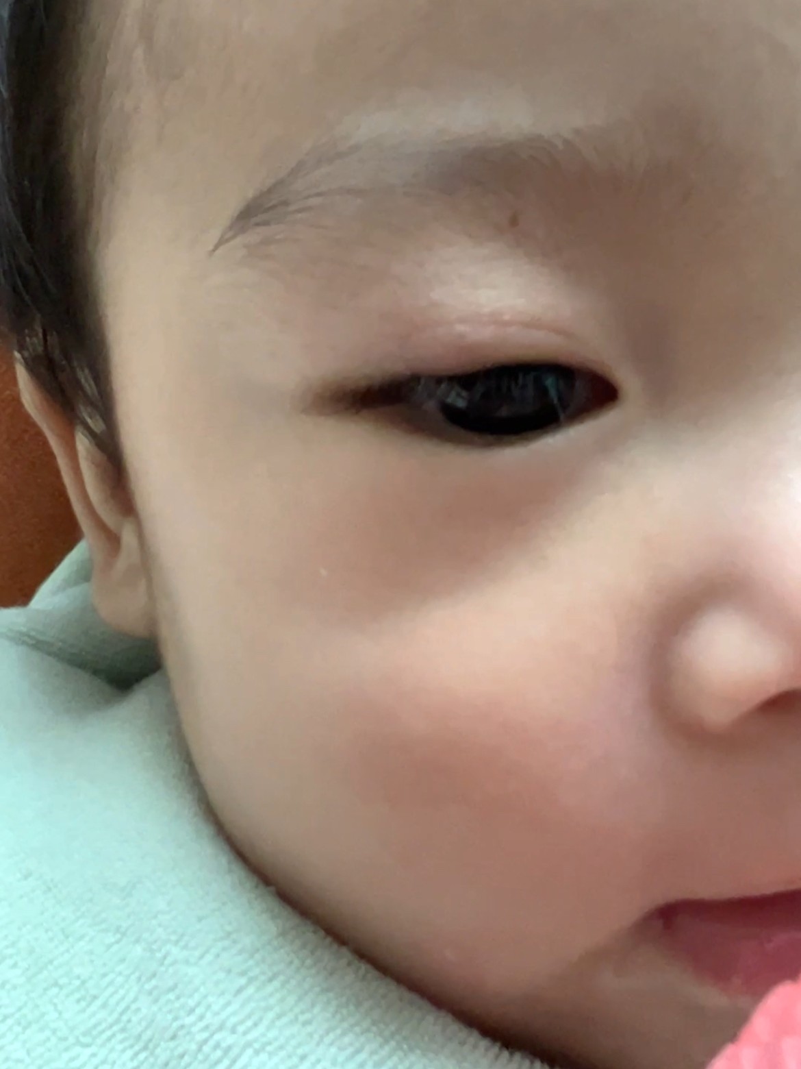 7개월 아기 눈다래끼 초기 증상 사진 - 콩다래끼 처음 발견된 모습