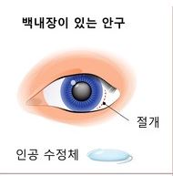 백내장 초기증상