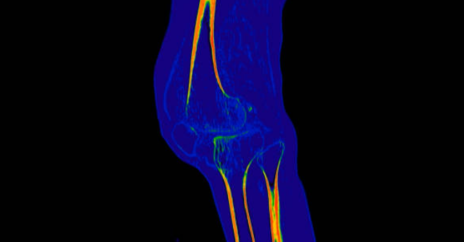 내측 인대 손상