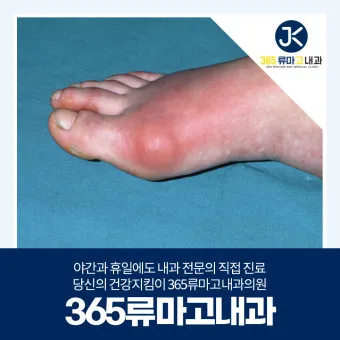 발가락 통풍 증상 및 대처방법_5