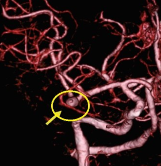 뇌동맥류 터지는 상황에서 응급처치 방법은?