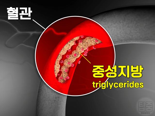 내장지방 고콜레스테롤혈증