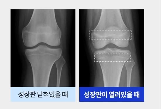 알파아이 키성장 영양제 추천