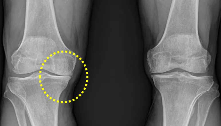 무릎-관절염에-좋은-운동-주의사항