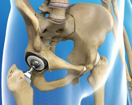고관절 인공관절