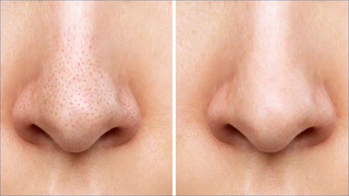 코 모공축소 전후